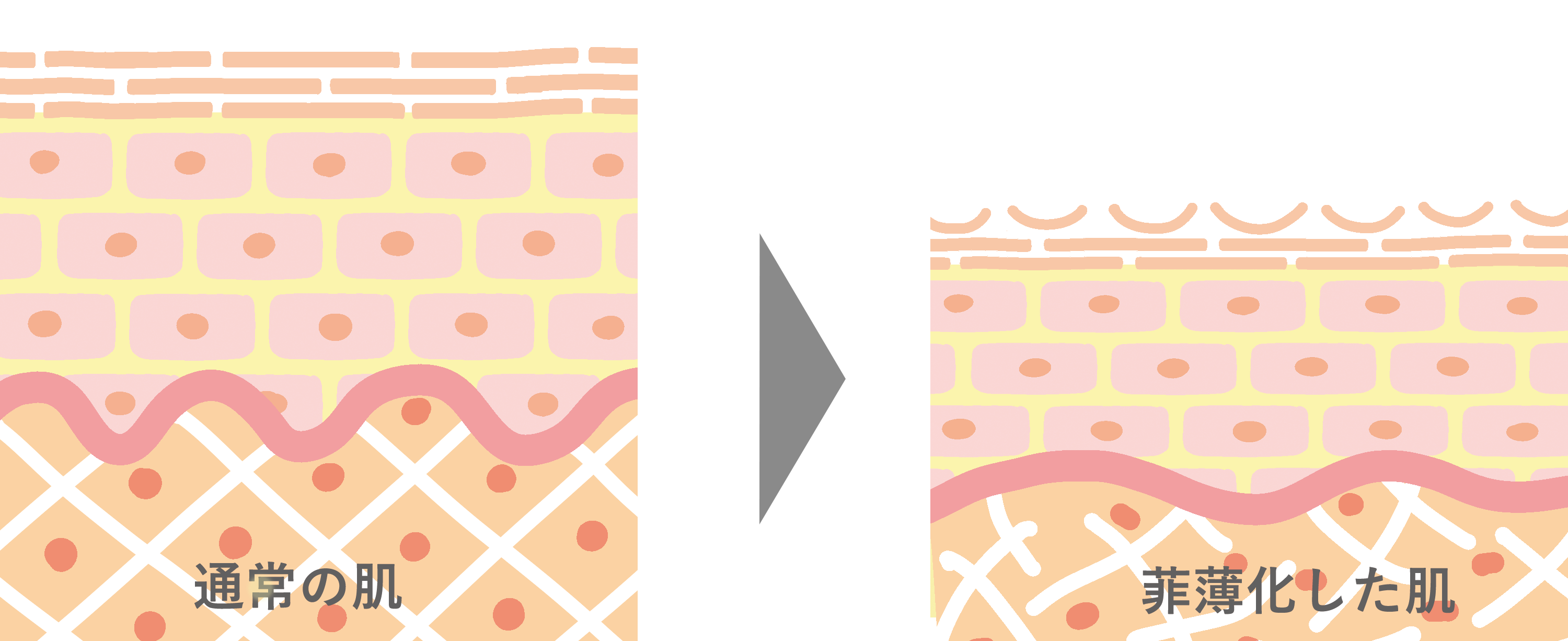 racosie(ラコシェ) 菲薄化した肌